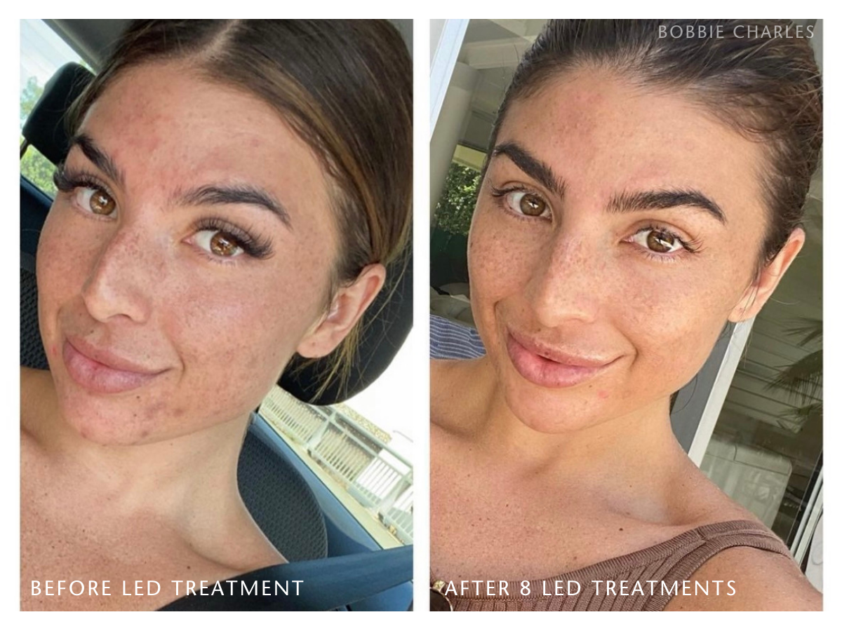 Results from 8 LED Treatments using Healite