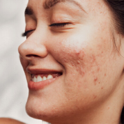 Must-Know-Secrets-to-control-acne