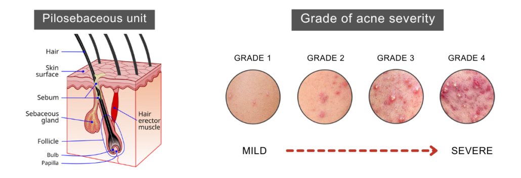 how acne is formed and the different grades of acne